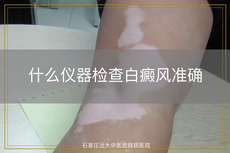 什么仪器检查白癜风准确