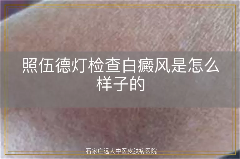 照伍德灯检查白癜风是怎么样子的