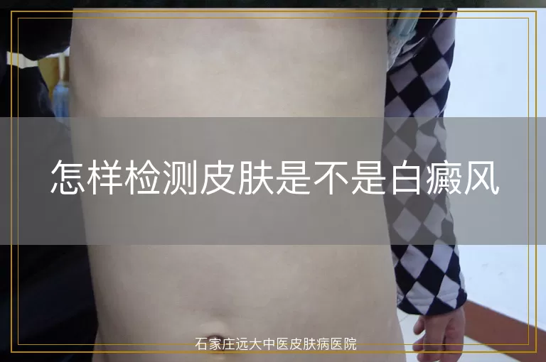 怎样检测皮肤是不是白癜风