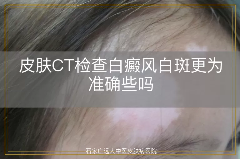 皮肤CT检查白癜风白斑更为准确些吗