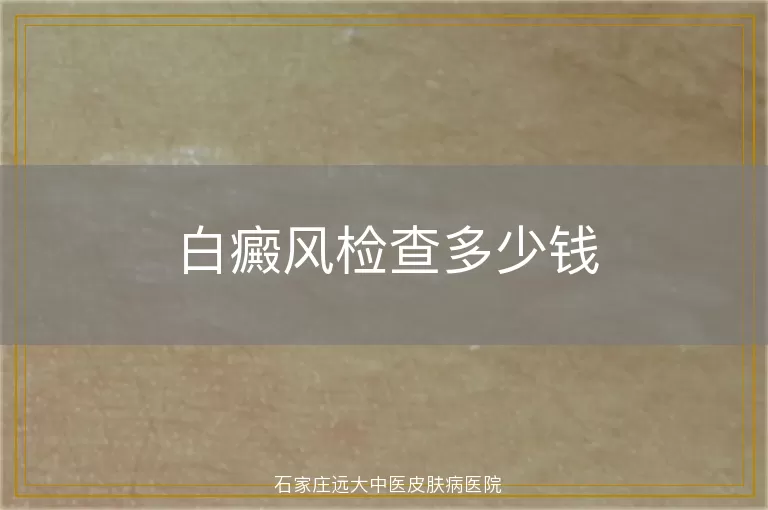 白癜风检查多少钱