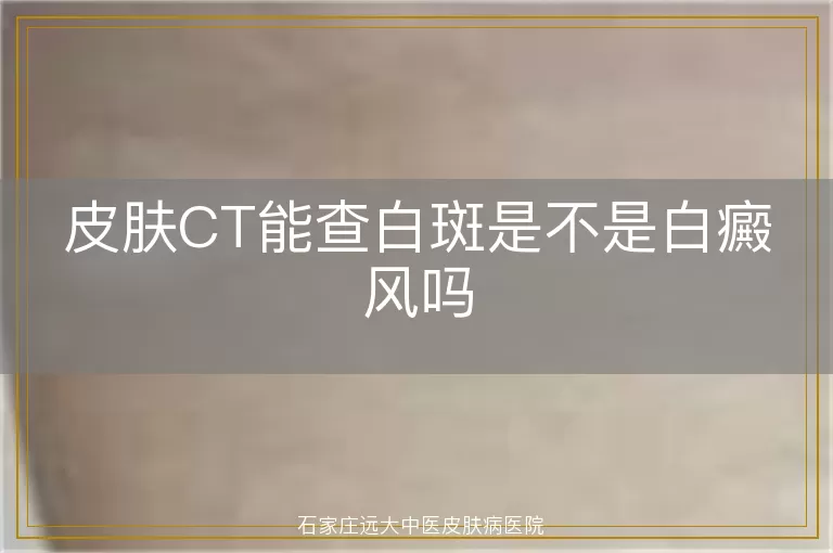 皮肤CT能查白斑是不是白癜风吗