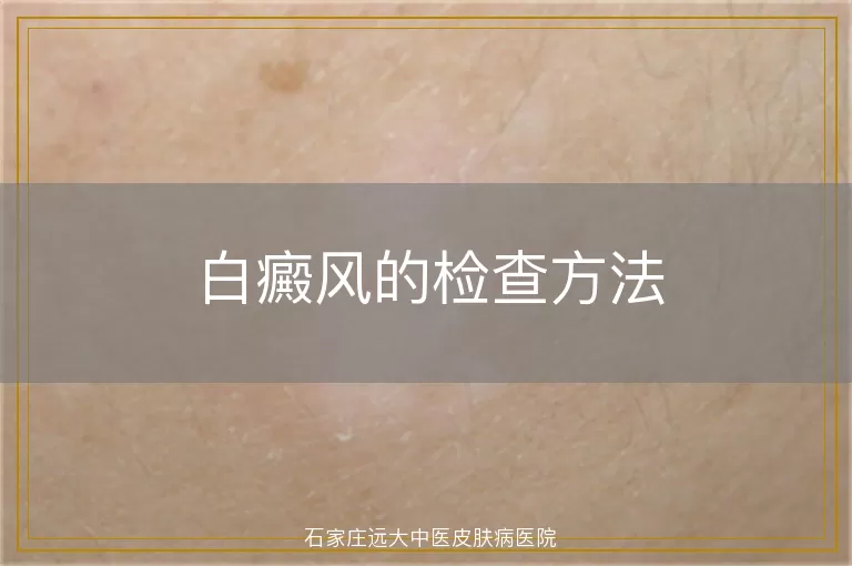 白癜风的检查方法
