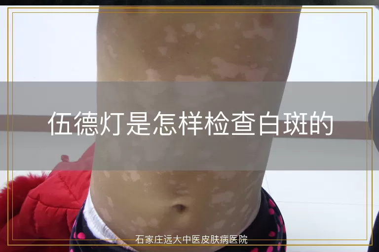伍德灯是怎样检查白斑的