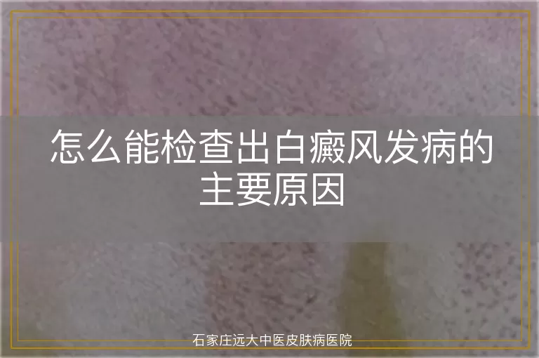 怎么能检查出白癜风发病的主要原因