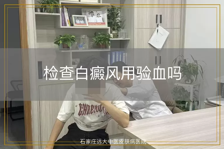 检查白癜风用验血吗