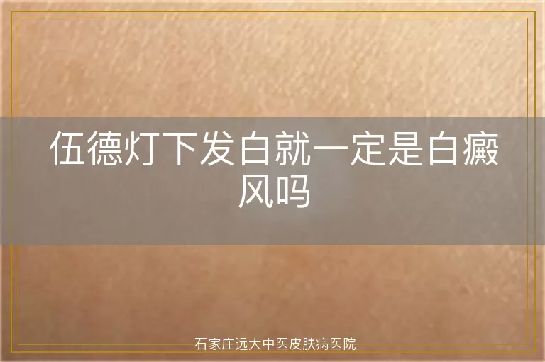 伍德灯下发白就一定是白癜风吗