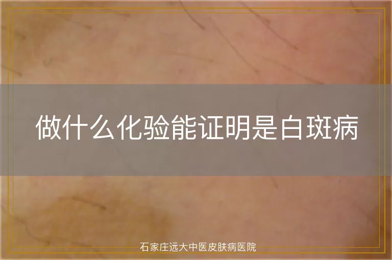 做什么化验能证明是白斑病