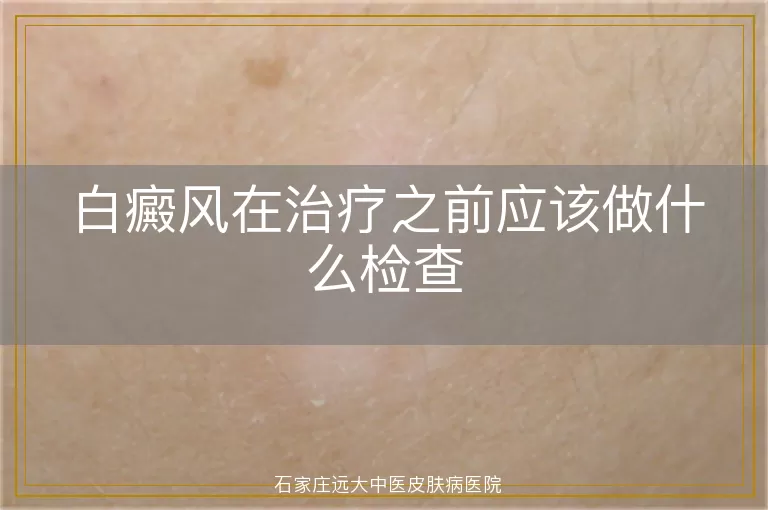 白癜风在治疗之前应该做什么检查