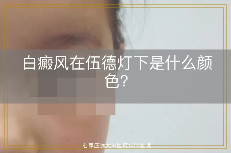 白癜风在伍德灯下是什么颜色?
