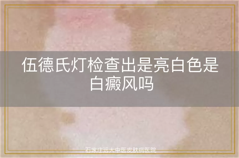 伍德氏灯检查出是亮白色是白癜风吗