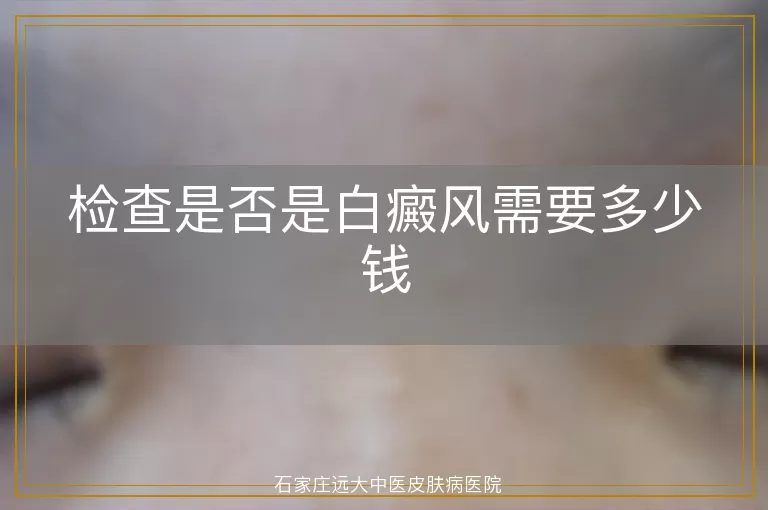 检查是否是白癜风需要多少钱