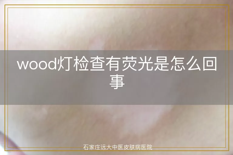 wood灯检查有荧光是怎么回事