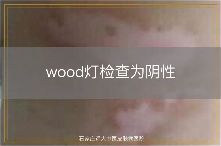 wood灯检查为阴性