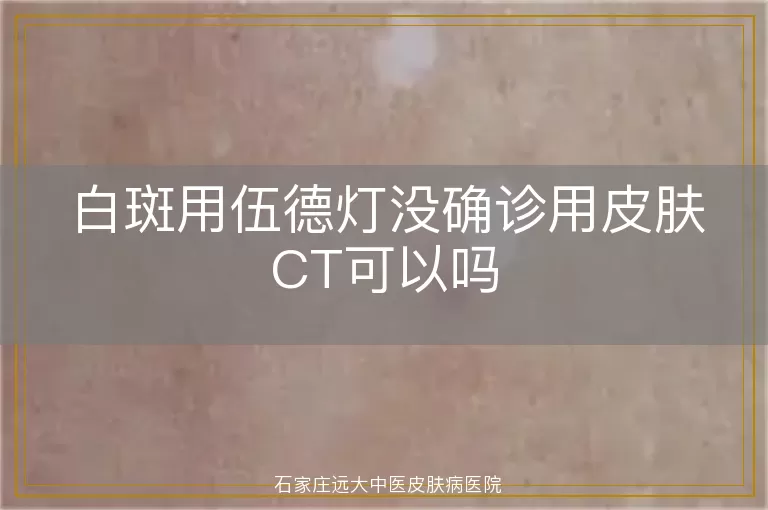 白斑用伍德灯没确诊用皮肤CT可以吗
