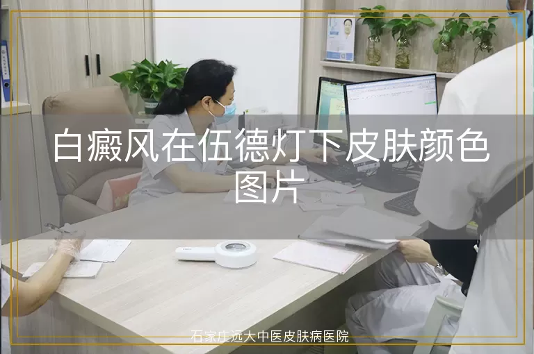 白癜风在伍德灯下皮肤颜色图片
