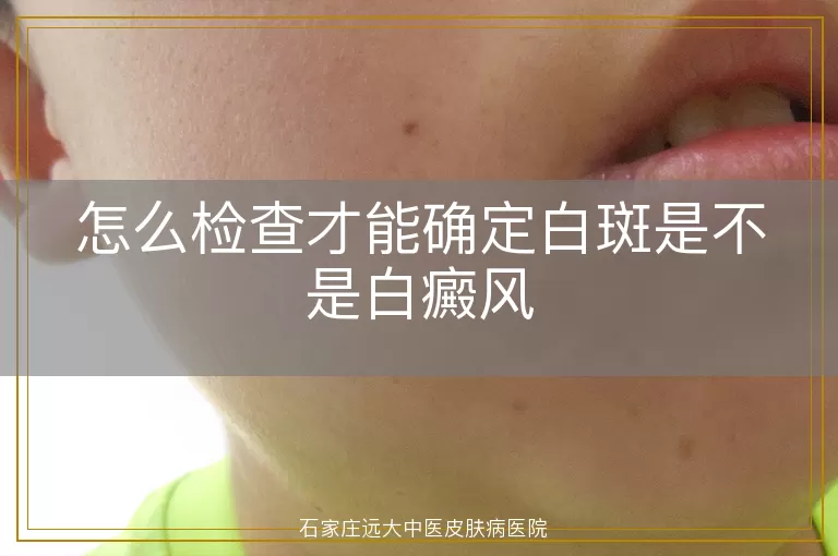 怎么检查才能确定白斑是不是白癜风