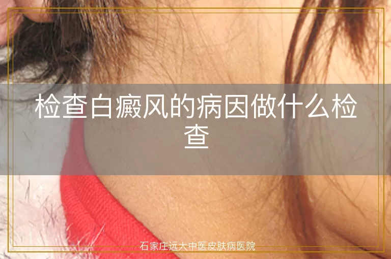 检查白癜风的病因做什么检查