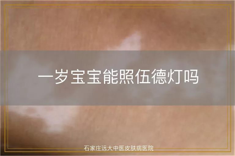 一岁宝宝能照伍德灯吗