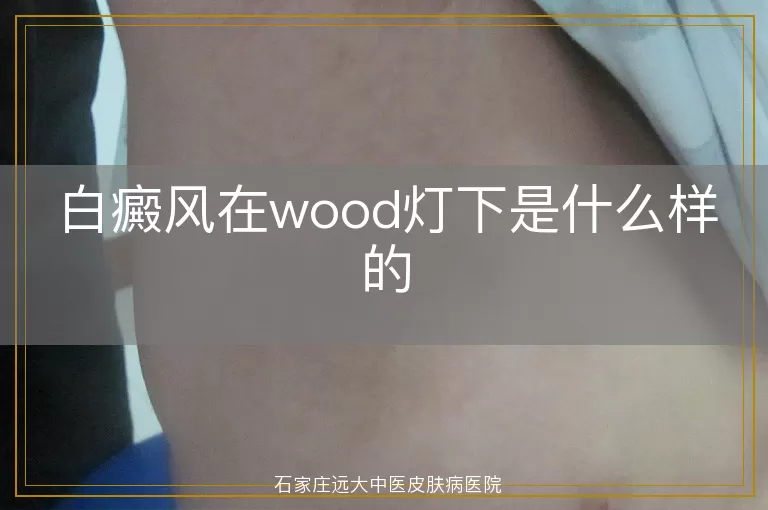 白癜风在wood灯下是什么样的