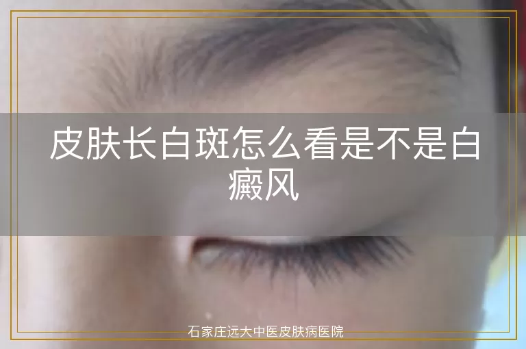 皮肤长白斑怎么看是不是白癜风
