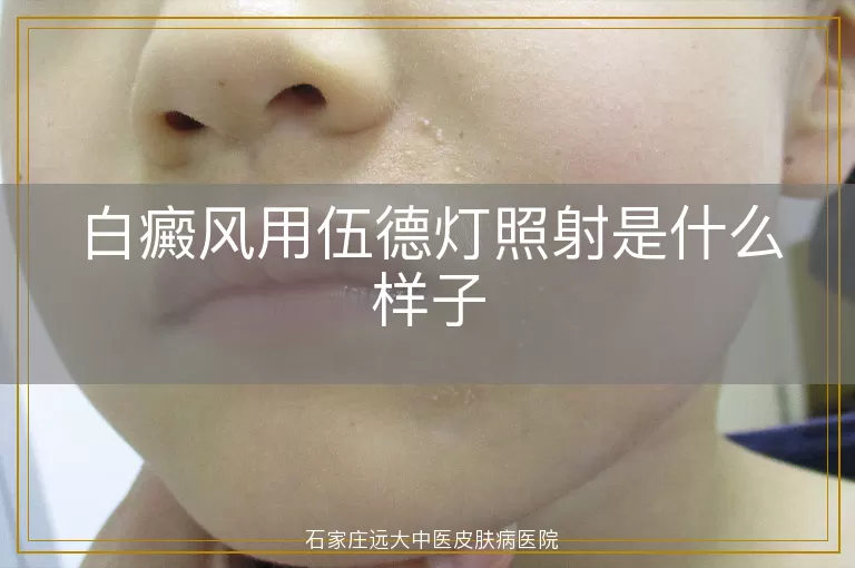 白癜风用伍德灯照射是什么样子