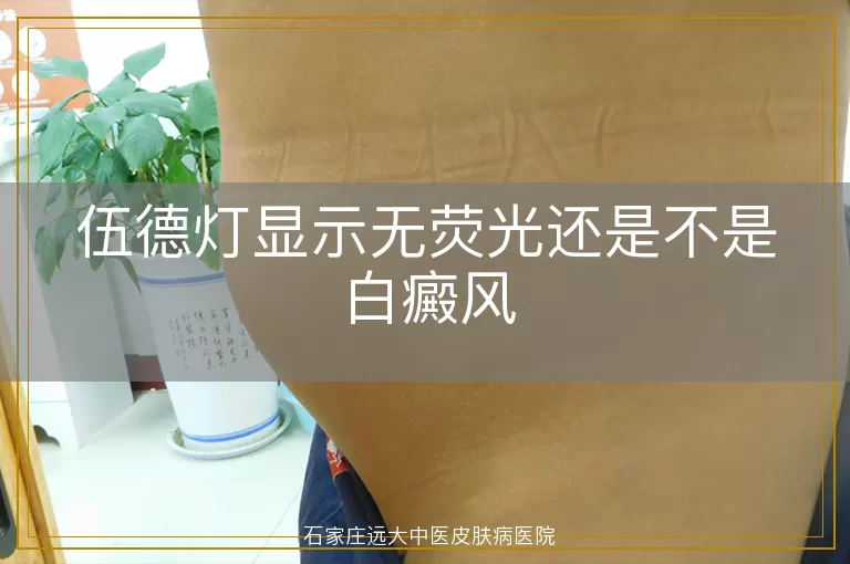 伍德灯显示无荧光还是不是白癜风