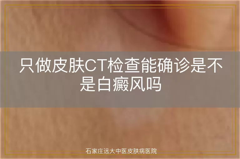 只做皮肤CT检查能确诊是不是白癜风吗