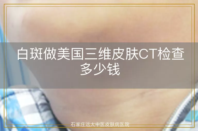 白斑做美国三维皮肤CT检查多少钱