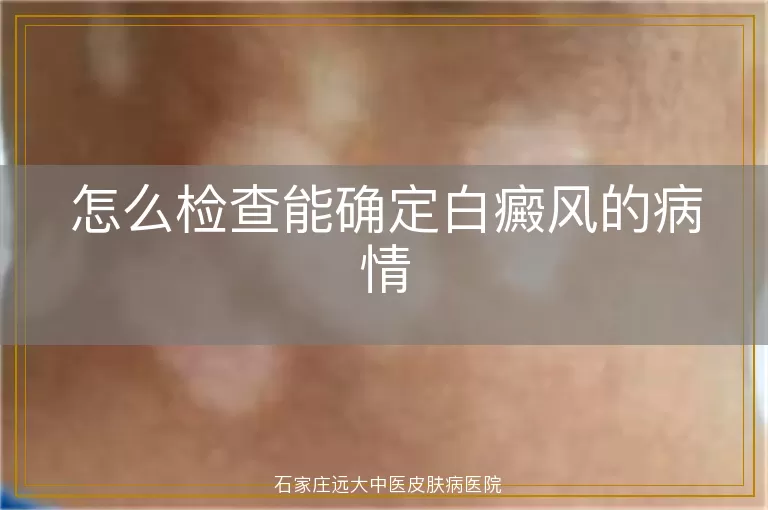 怎么检查能确定白癜风的病情