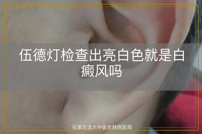 伍德灯检查出亮白色就是白癜风吗