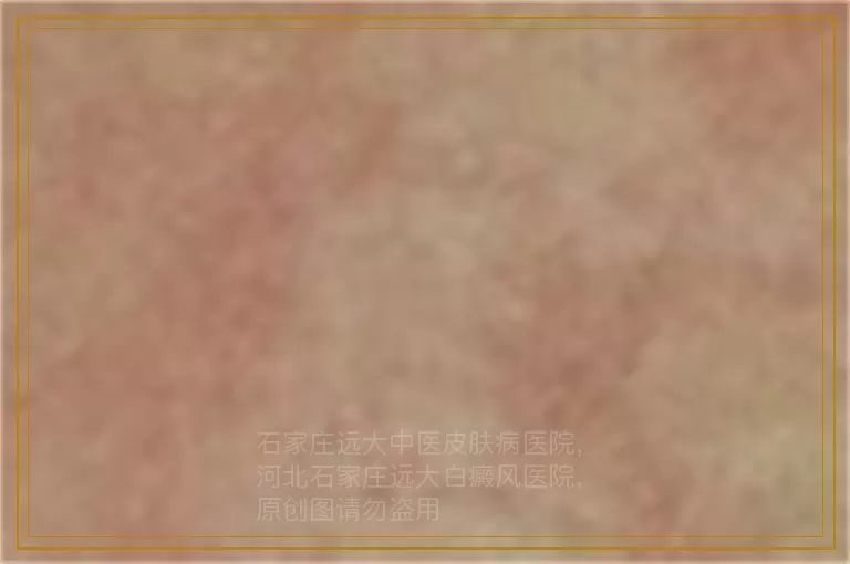 到医院去一般要检查白癜风哪几项呢