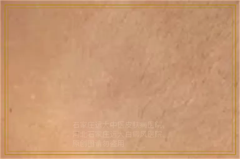 白癜风检查为什么要化验血
