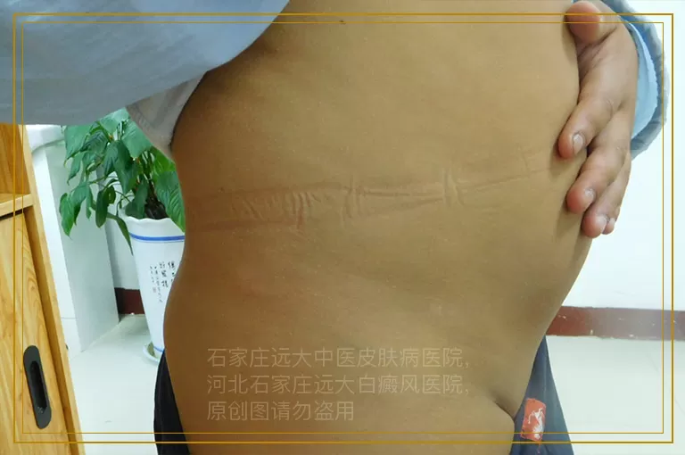 WOOD灯检测白癜风