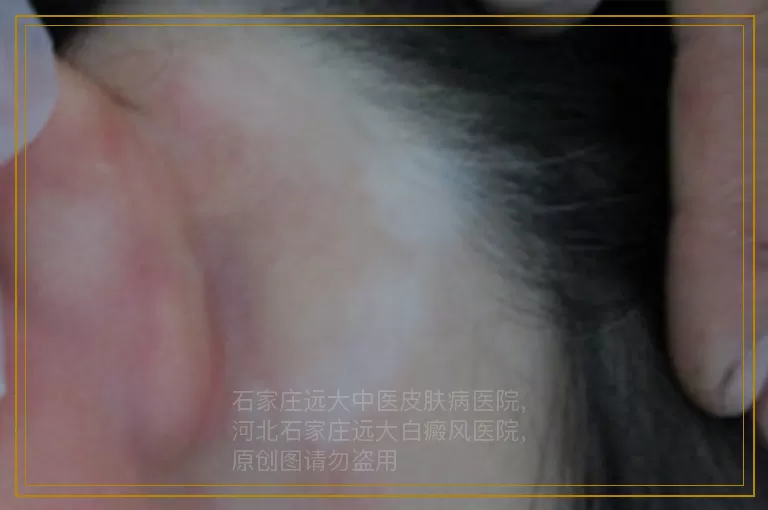 白癜风检查结果多长时间出来