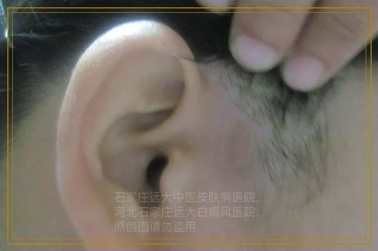 身体有小白点是白癜风吗