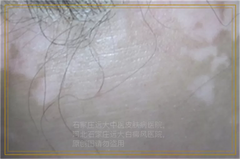 身上白了一片是白癜风的症状吗