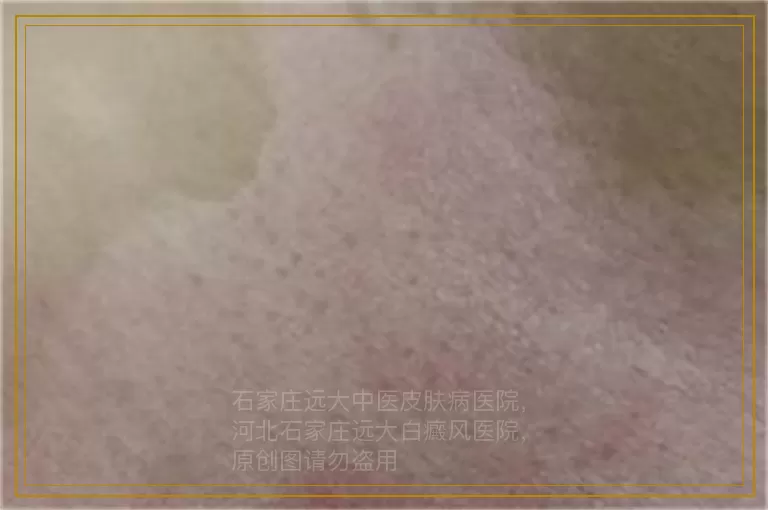 手上有白斑需要做哪些检查