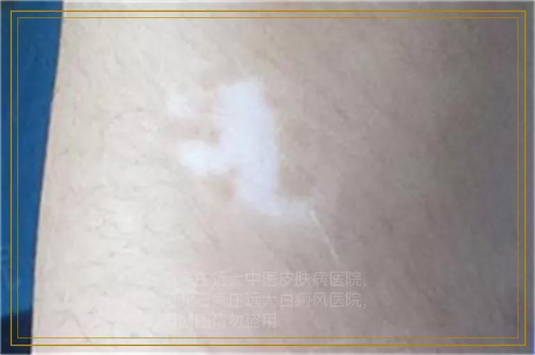 小白点能确诊为白癜风吗