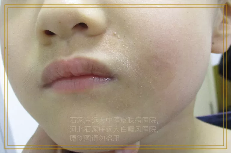 白癜风和正常皮肤在伍德灯下的区别
