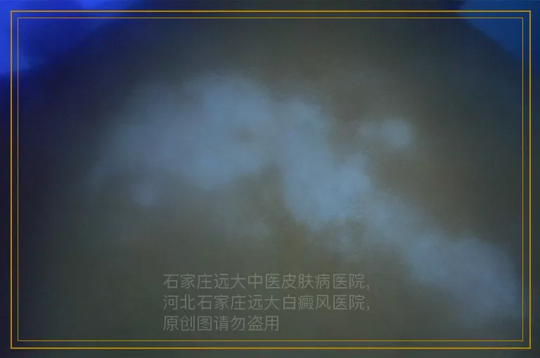 白癜风初期伍德灯检查准不准