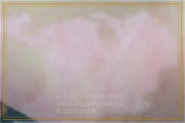 初期不明显的白斑伍德灯能检查出来吗