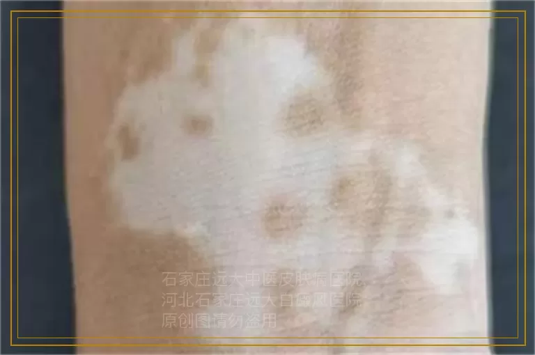 伍德灯照出亮白色就是白癜风吗