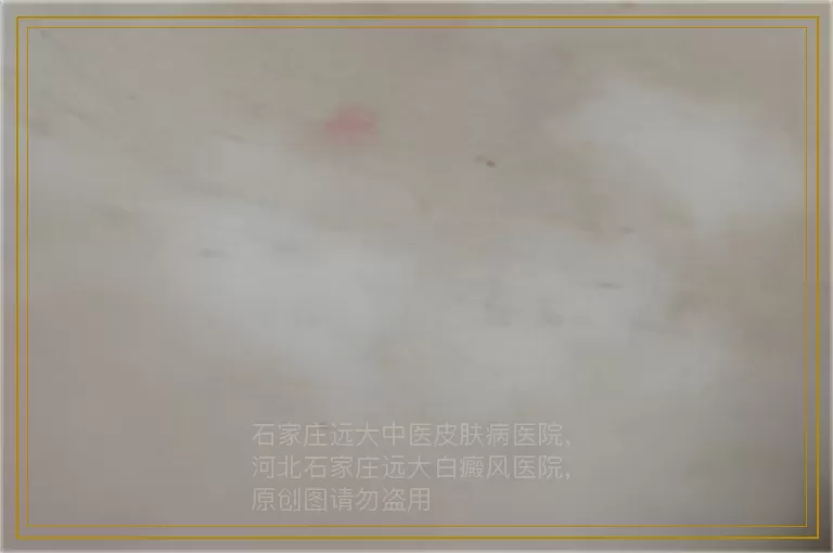 伍德灯检查怀疑是白癜风怎么确诊