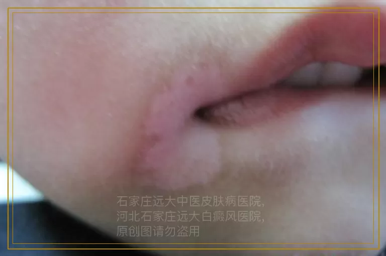 胸口上有一块一块的白斑是怎么回事