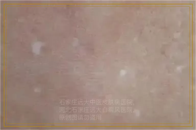 确诊白斑是不是白癜风为什么做皮肤ct