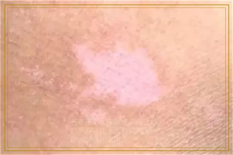 青少年白癜风治疗白斑前做什么检查
