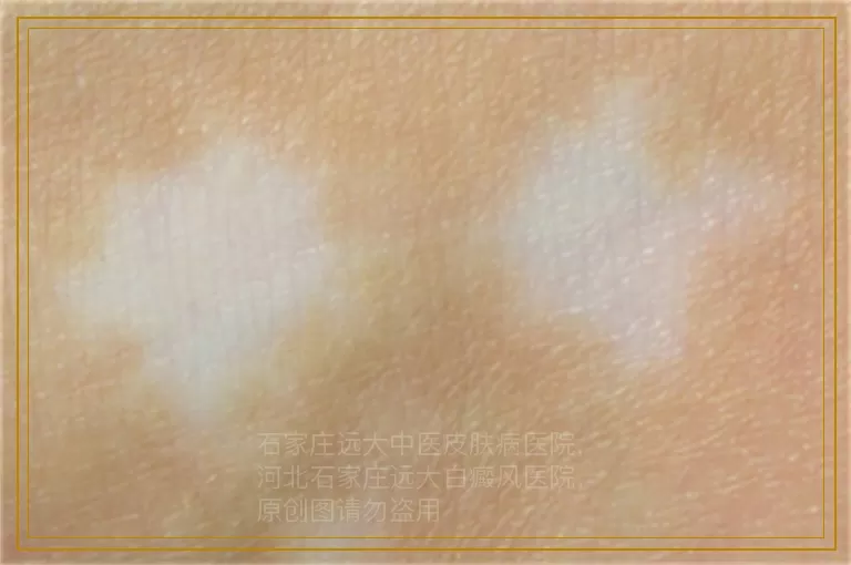 wood灯检查白斑准确率高吗