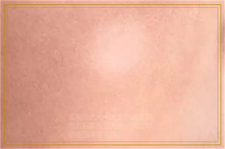 怎么看小孩身上白点是不是白癜风