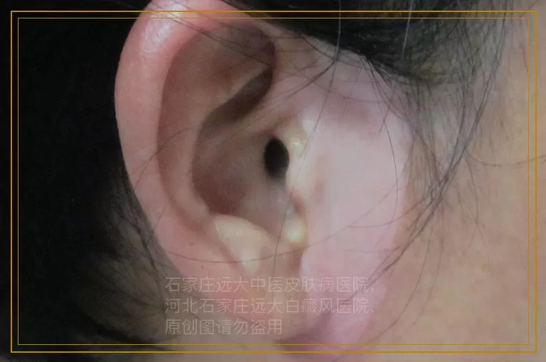 检测白斑都需要做哪些检查